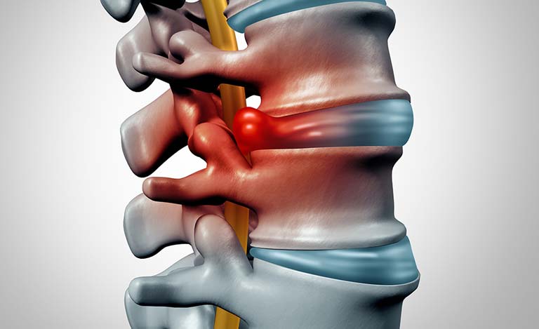 Disc Herniation Causes